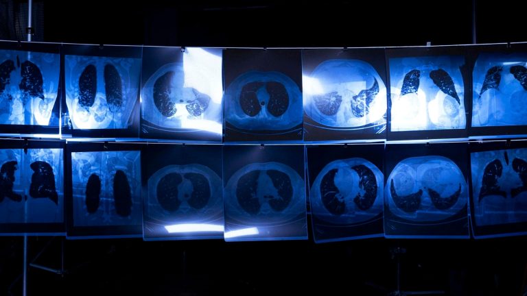 ‘Regulators are failing’: Lawyer Gary Koutzoumis demands action on incurable lung disease